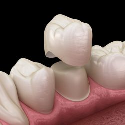 Dental crown premolar tooth assembly process. Medically accurate 3D illustration of human teeth treatment
